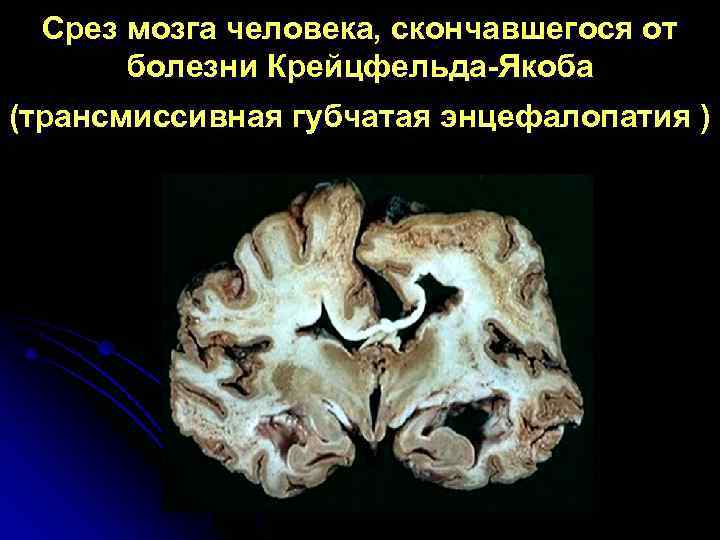  Срез мозга человека, скончавшегося от  болезни Крейцфельда-Якоба (трансмиссивная губчатая энцефалопатия ) 