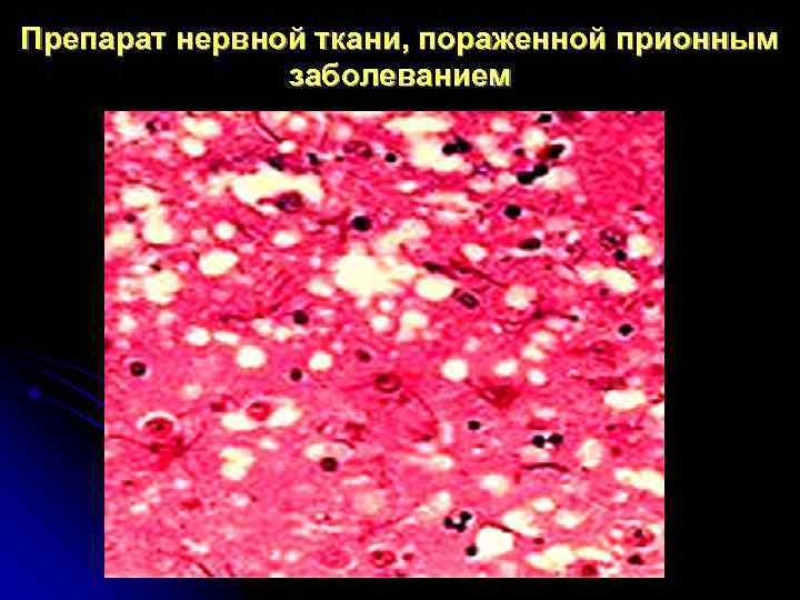 Препарат нервной ткани, пораженной прионным   заболеванием 