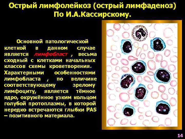  Острый лимфолейкоз (острый лимфаденоз)  По И. А. Кассирскому.  Основной патологической клеткой