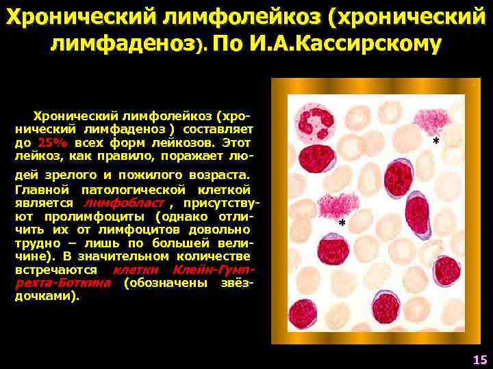 Хронический лимфолейкоз (хронический  лимфаденоз). По И. А. Кассирскому Хронический лимфолейкоз (хро- нический лимфаденоз