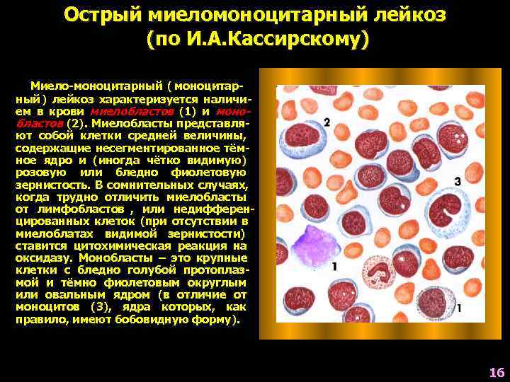   Острый миеломоноцитарный лейкоз    (по И. А. Кассирскому)  Миело-моноцитарный