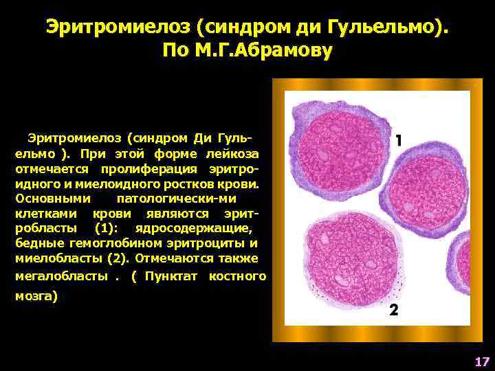   Эритромиелоз (синдром ди Гульельмо).    По М. Г. Абрамову Эритромиелоз