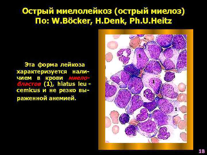  Острый миелолейкоз (острый миелоз) По: W. Böcker, H. Denk, Ph. U. Heitz 
