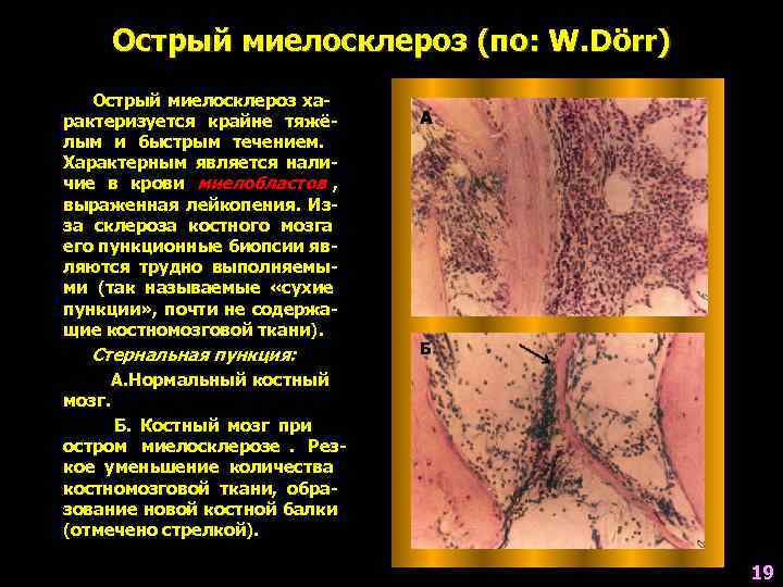   Острый миелосклероз (по: W. Dörr)  Острый миелосклероз ха- рактеризуется крайне тяжё-