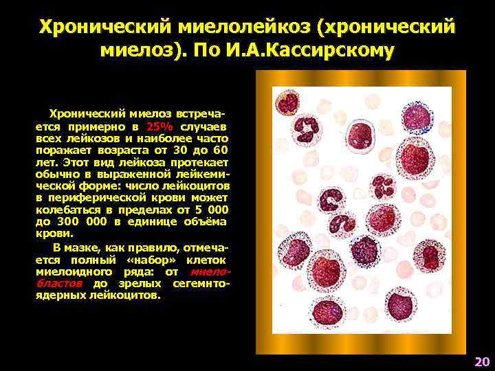 Хронический миелолейкоз (хронический миелоз). По И. А. Кассирскому Хронический миелоз встреча- ется примерно в