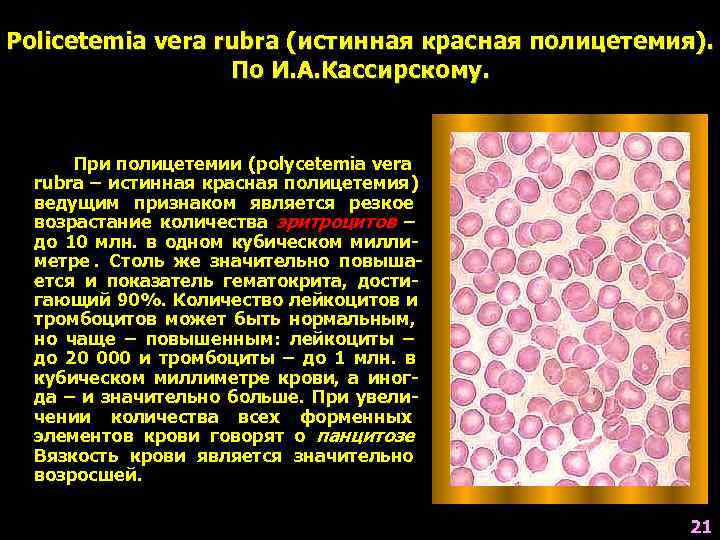 Policetemia vera rubra (истинная красная полицетемия).    По И. А. Кассирскому. 