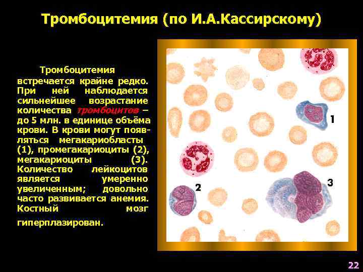 Лечение тромбоцитемии