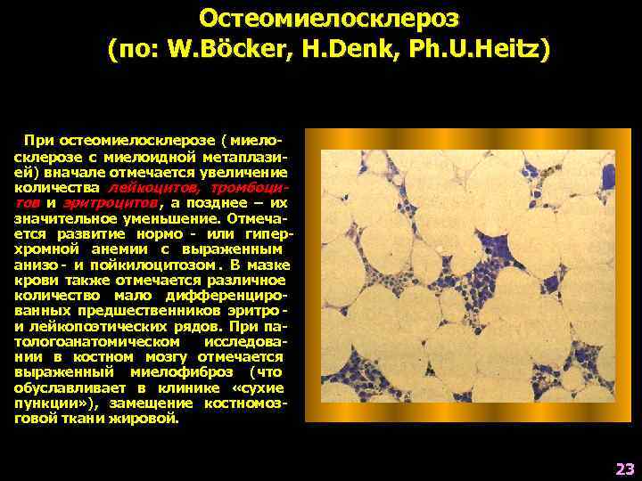    Остеомиелосклероз  (по: W. Böcker, H. Denk, Ph. U. Heitz) 