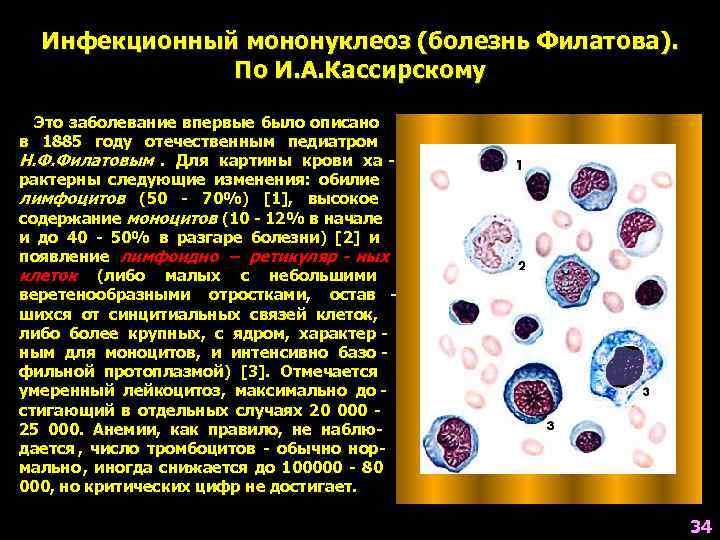  Инфекционный мононуклеоз (болезнь Филатова).    По И. А. Кассирскому  Это