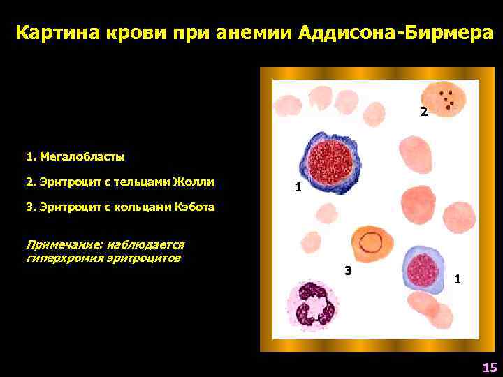 Картина крови при анемии