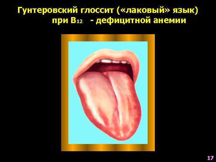 Гунтеровский глоссит ( «лаковый» язык)  при В 12 - дефицитной анемии  