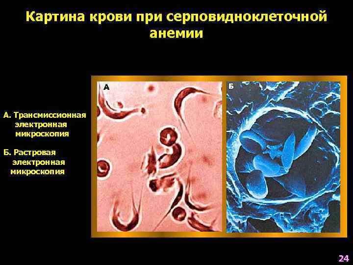  Картина крови при серповидноклеточной     анемии А. Трансмиссионная  электронная