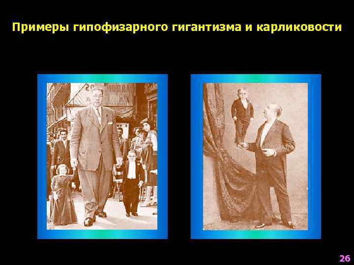 Примеры гипофизарного гигантизма и карликовости     26 
