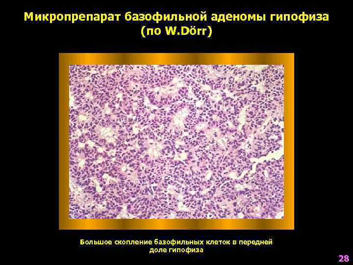 Микропрепарат базофильной аденомы гипофиза   (по W. Dörr)  Большое скопление базофильных клеток