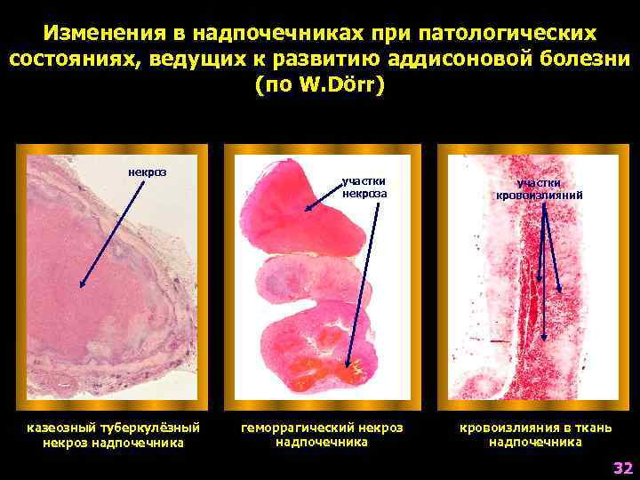   Изменения в надпочечниках при патологических состояниях, ведущих к развитию аддисоновой болезни 