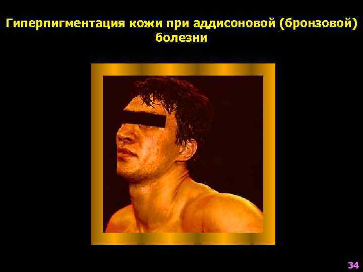 Гиперпигментация кожи при аддисоновой (бронзовой)     болезни    