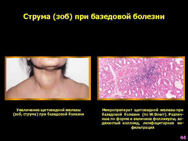  Струма (зоб) при базедовой болезни  Увеличение щитовидной железы  Микропрепарат щитовидной железы