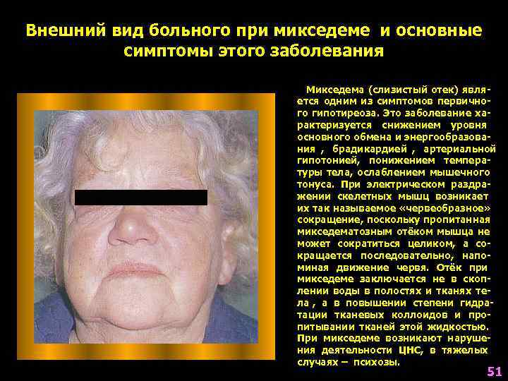 Внешний вид больного при микседеме и основные  симптомы этого заболевания   