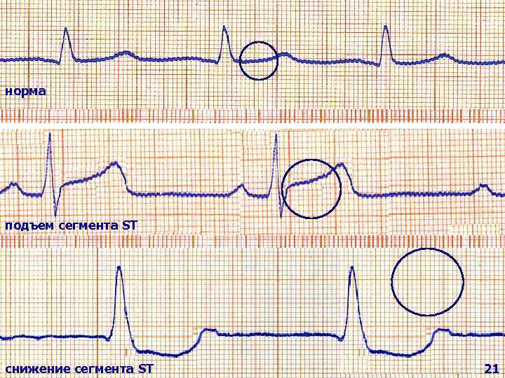      R     * Схема смещения сегмента