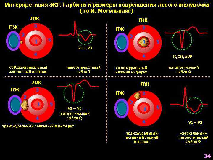  Интерпретация ЭКГ. Глубина и размеры повреждения левого желудочка     (по