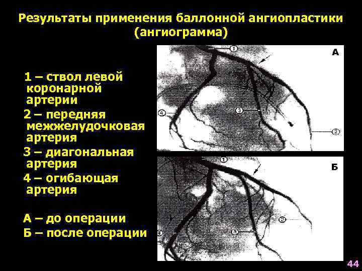 Результаты применения баллонной ангиопластики   (ангиограмма)  1 – ствол левой коронарной артерии