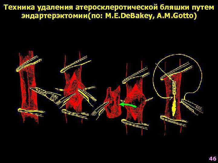 Техника удаления атеросклеротической бляшки путем эндартерэктомии(по: M. E. De. Bakey, A. M. Gotto) 