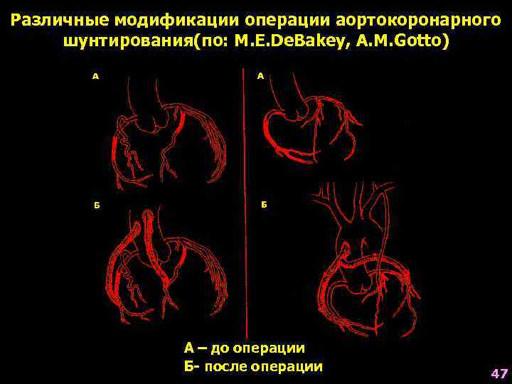Различные модификации операции аортокоронарного шунтирования(по: M. E. De. Bakey, A. M. Gotto)  