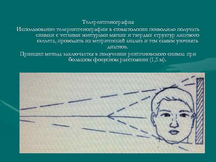     Телерентгенография Использование телерентгенографии в стоматологии позволило получать  снимки с