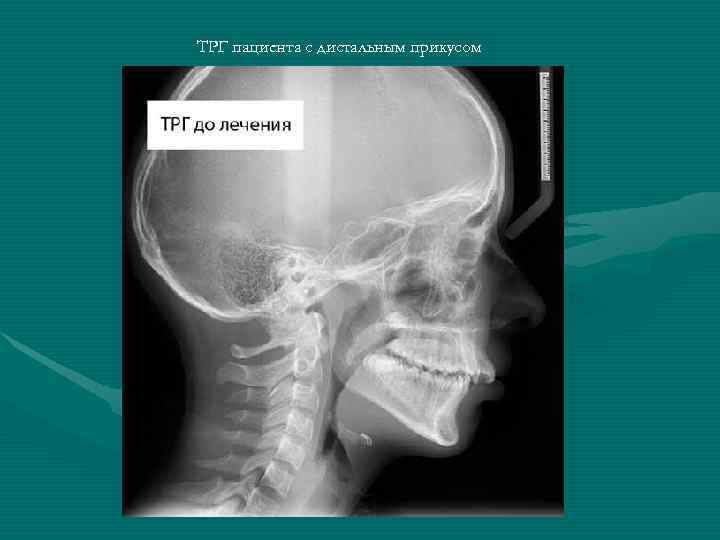 ТРГ пациента с дистальным прикусом 