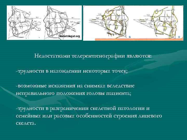  Недостатками телерентгенографии являются:  -трудности в нахождении некоторых точек;  -возможные искажения на
