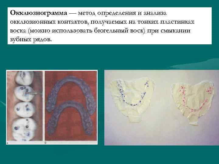 Окклюзиограмма — метод определения и анализа окклюзионных контактов, получаемых на тонких пластинках воска (можно