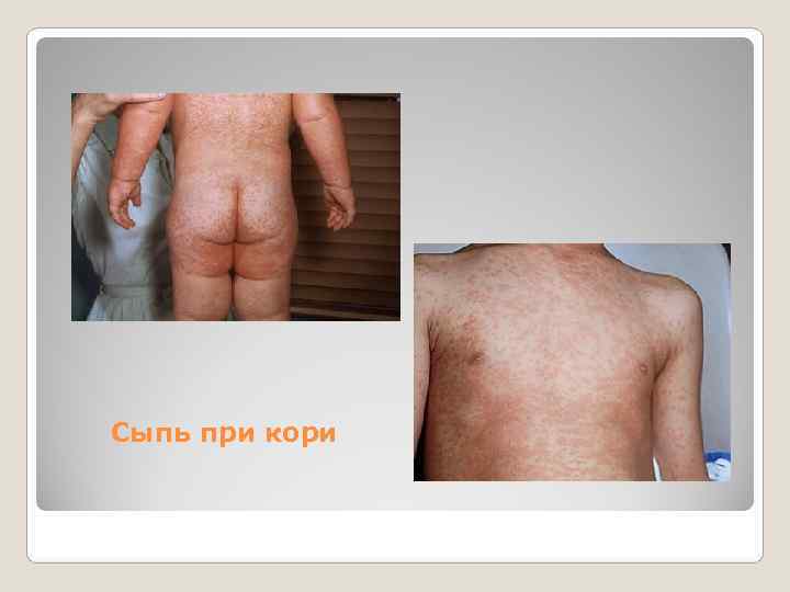 Сыпь при кори 
