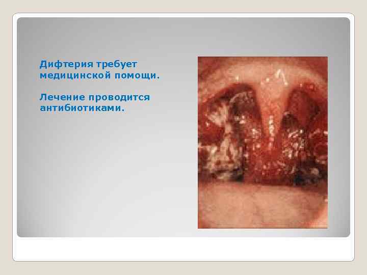 Дифтерия требует медицинской помощи.  Лечение проводится антибиотиками.  