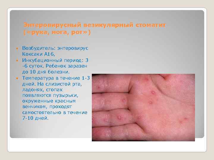   Энтеровирусный везикулярный стоматит   ( «рука, нога, рот» )  Возбудитель: