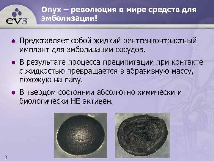    Onyx – революция в мире средств для   эмболизации! l