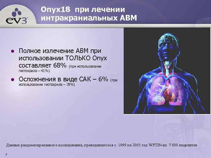     Onyx 18 при лечении     интракраниальных АВМ