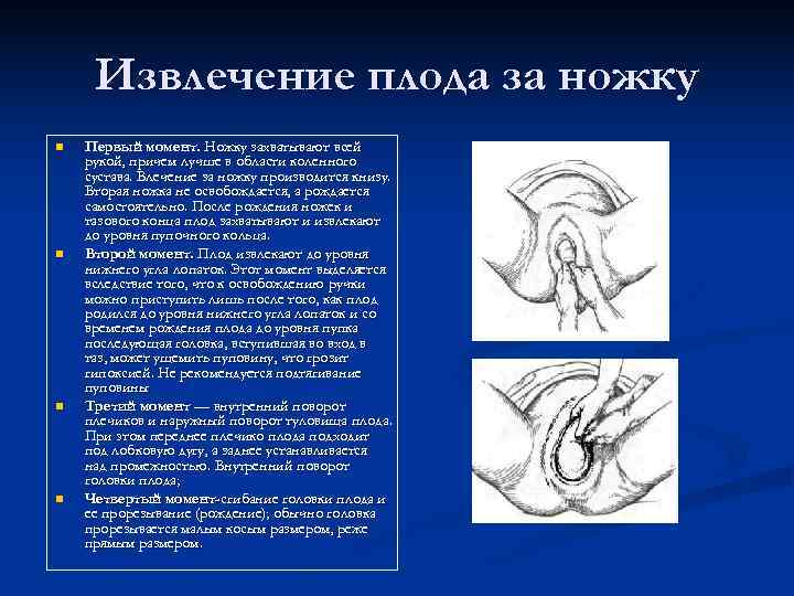  Извлечение плода за ножку n  Первый момент. Ножку захватывают всей рукой, причем