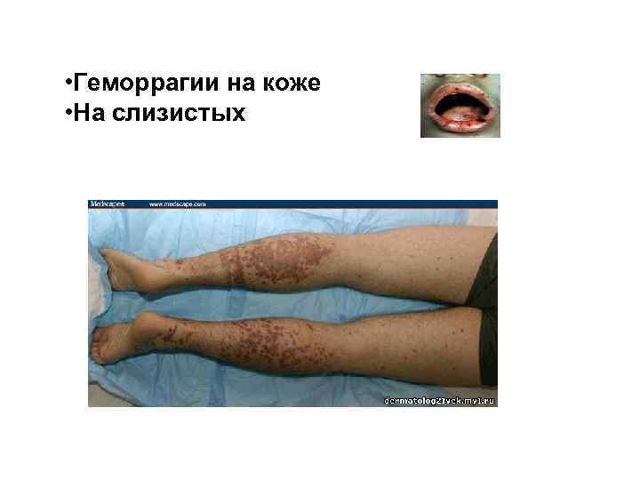  • Геморрагии на коже • На слизистых 