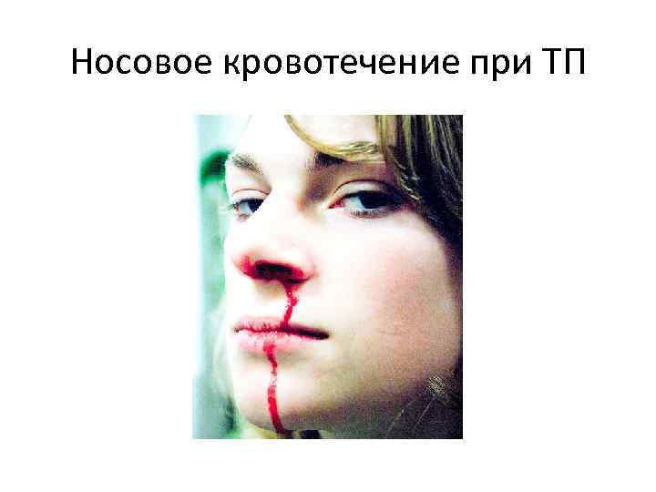 Носовое кровотечение при ТП 
