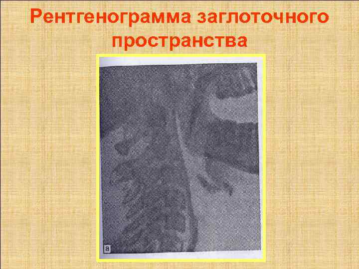 Рентгенограмма заглоточного  пространства 