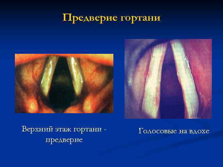    Предверие гортани Верхний этаж гортани -  Голосовые на вдохе предверие