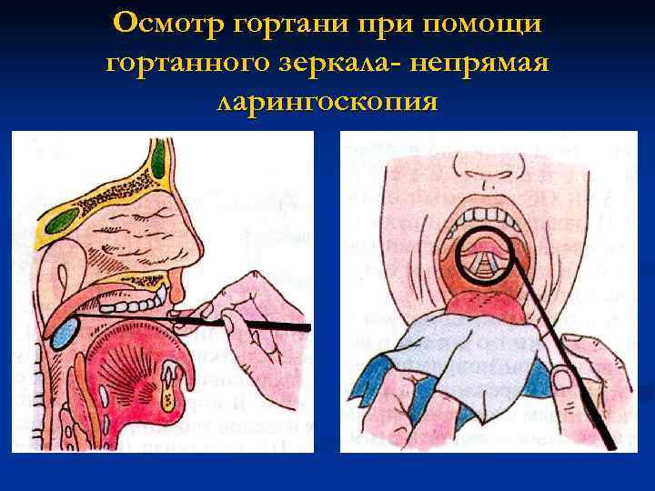  Осмотр гортани при помощи гортанного зеркала- непрямая  ларингоскопия 