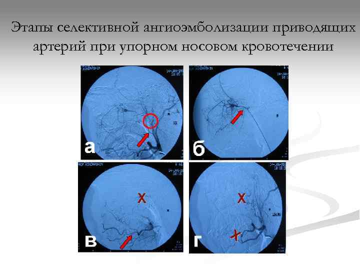 Этапы селективной ангиоэмболизации приводящих  артерий при упорном носовом кровотечении 