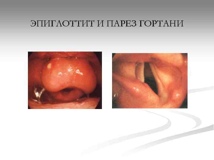 ЭПИГЛОТТИТ И ПАРЕЗ ГОРТАНИ 