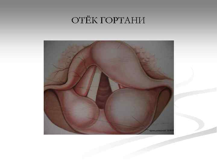 ОТЁК ГОРТАНИ 
