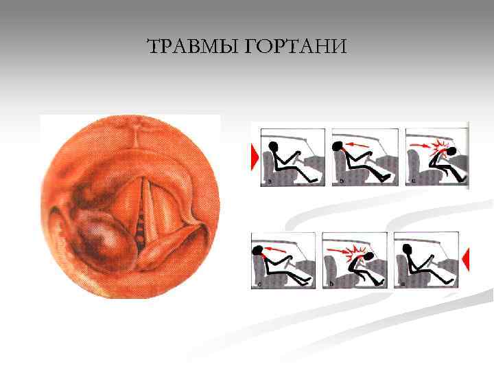 ТРАВМЫ ГОРТАНИ 