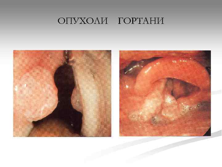 ОПУХОЛИ ГОРТАНИ 