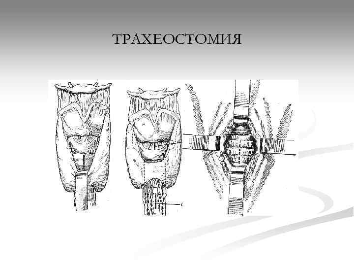 ТРАХЕОСТОМИЯ 