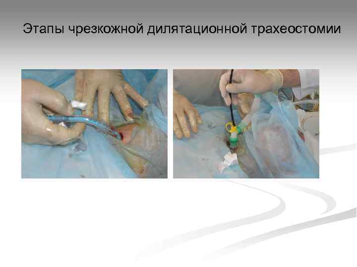 Этапы чрезкожной дилятационной трахеостомии 