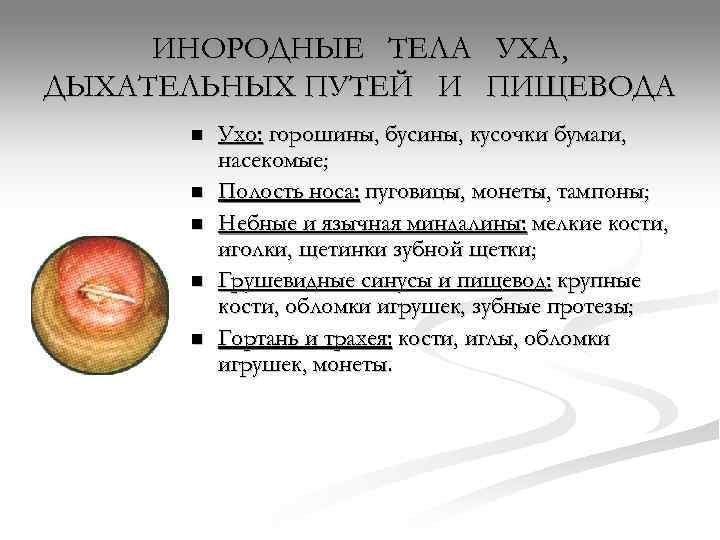  ИНОРОДНЫЕ ТЕЛА УХА, ДЫХАТЕЛЬНЫХ ПУТЕЙ И ПИЩЕВОДА  n  Ухо: горошины, бусины,
